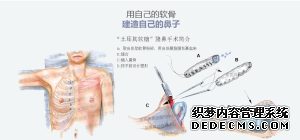 肋软骨隆鼻手术