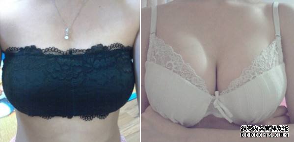 乳房下垂矫正