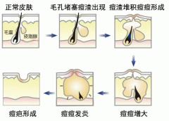 激光祛痘手术后的注意事项是什么